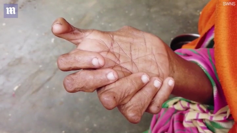 زنی هندی با انگشتانی عجیب و غریب