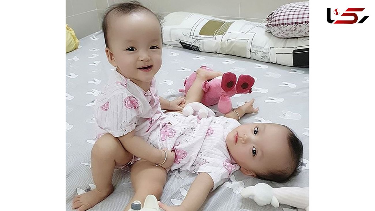 جداسازی دوقلوهای بهم چسبیده با کمک 100 جراح و متخصص + عکس /  ویتنام