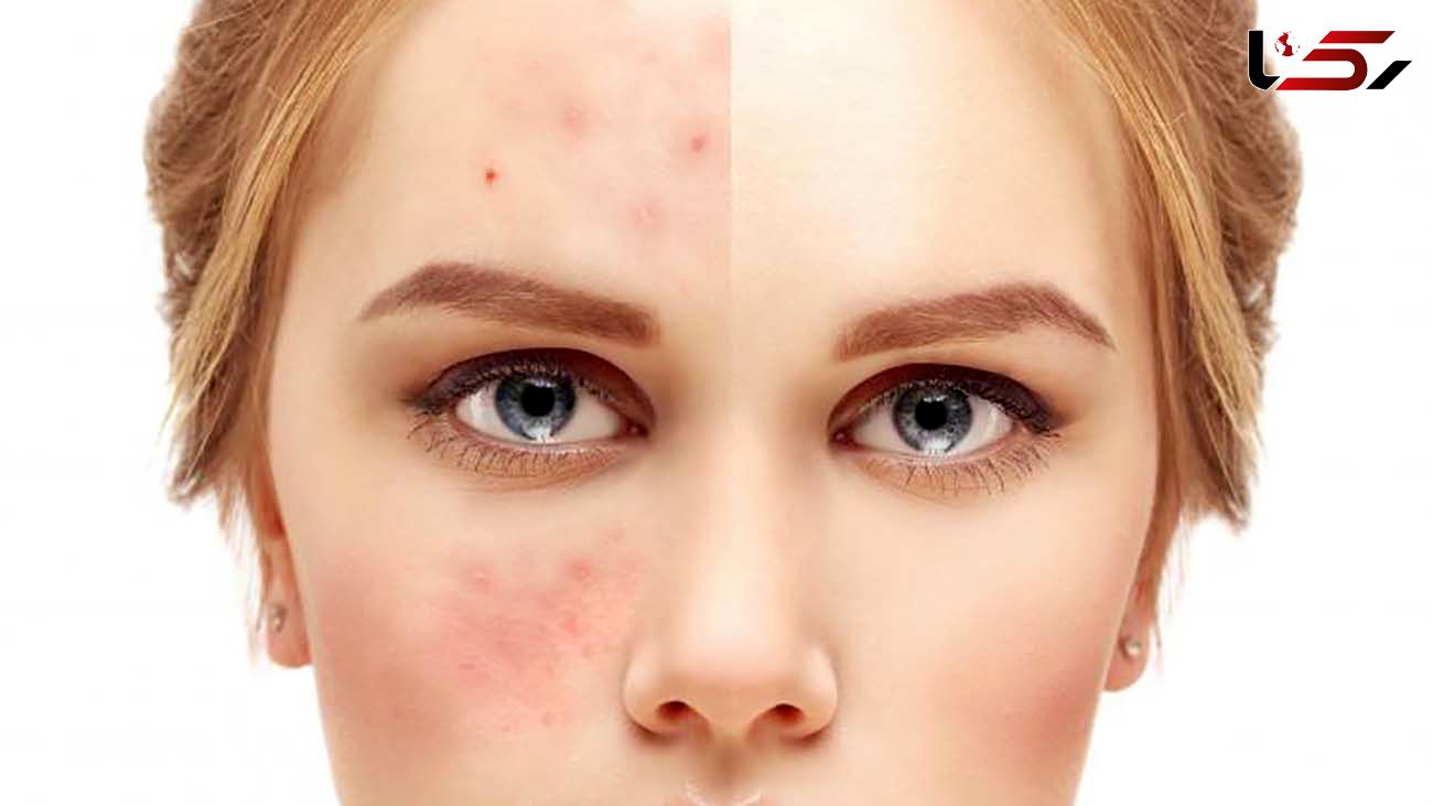 پوست چرب و دارای جوش‌ را در خانه پاکسازی کنید