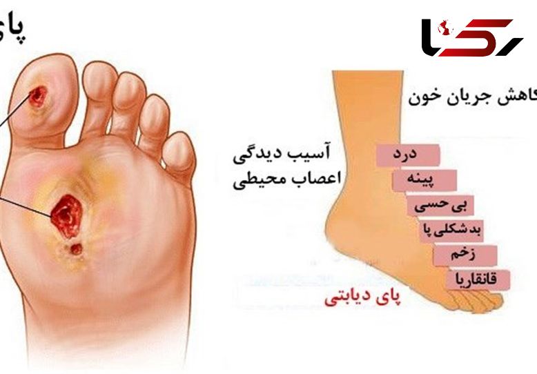 این زخم کشنده‌تر از سرطان است! + جزییات وحشتناک