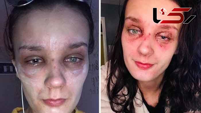 بلایی که تخم مرغ آب پز بر سر دختر 19 ساله آورد + عکس 