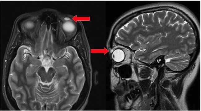 عجیب‌ترین‌های دنیای پزشکی / از عفونتی‌که مغز را می‌بلعد تا انگلی که در ستون فقرات پیدا شد